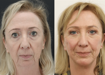 Facelift Surgery in London
