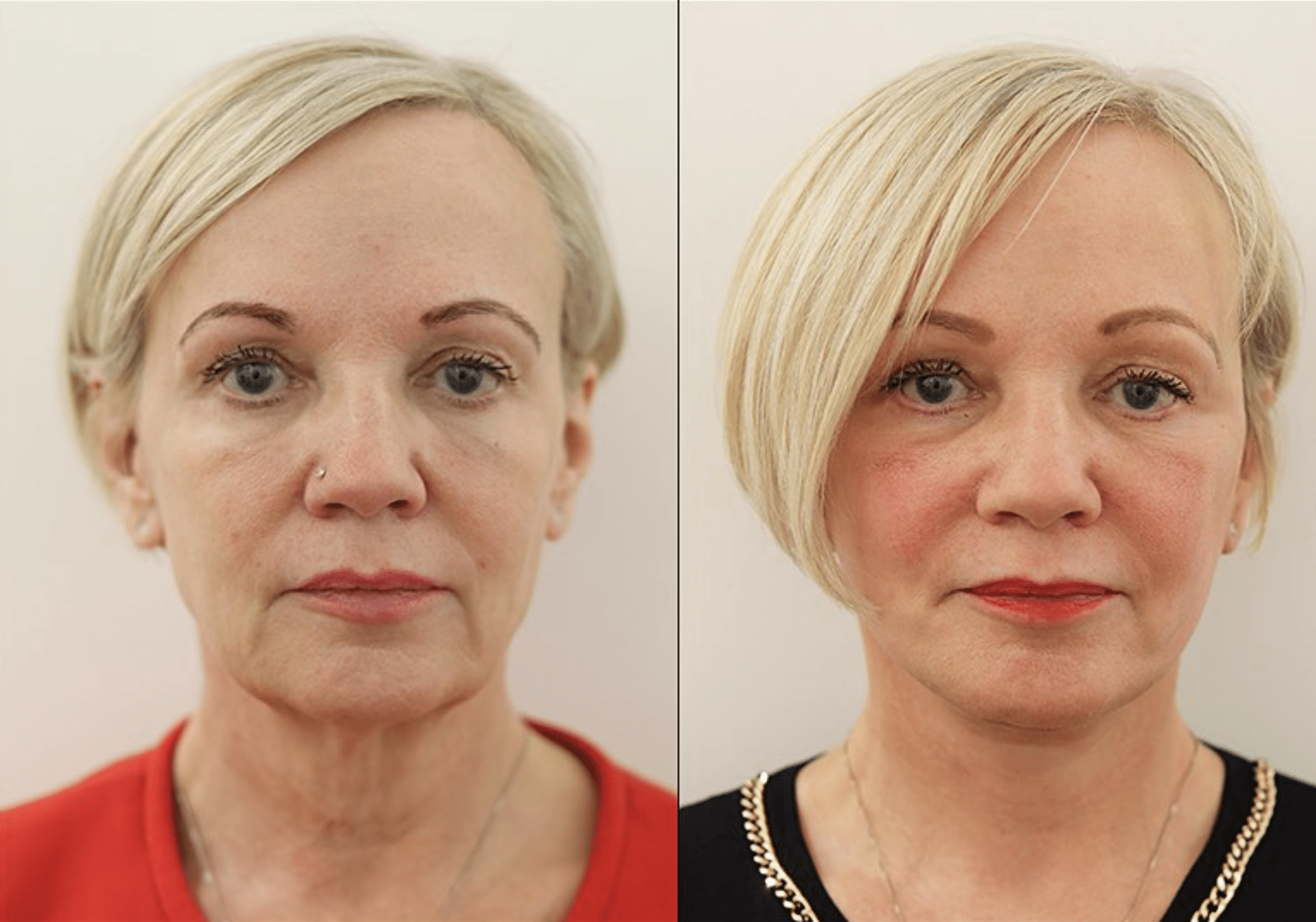 Facelift Surgery in London 