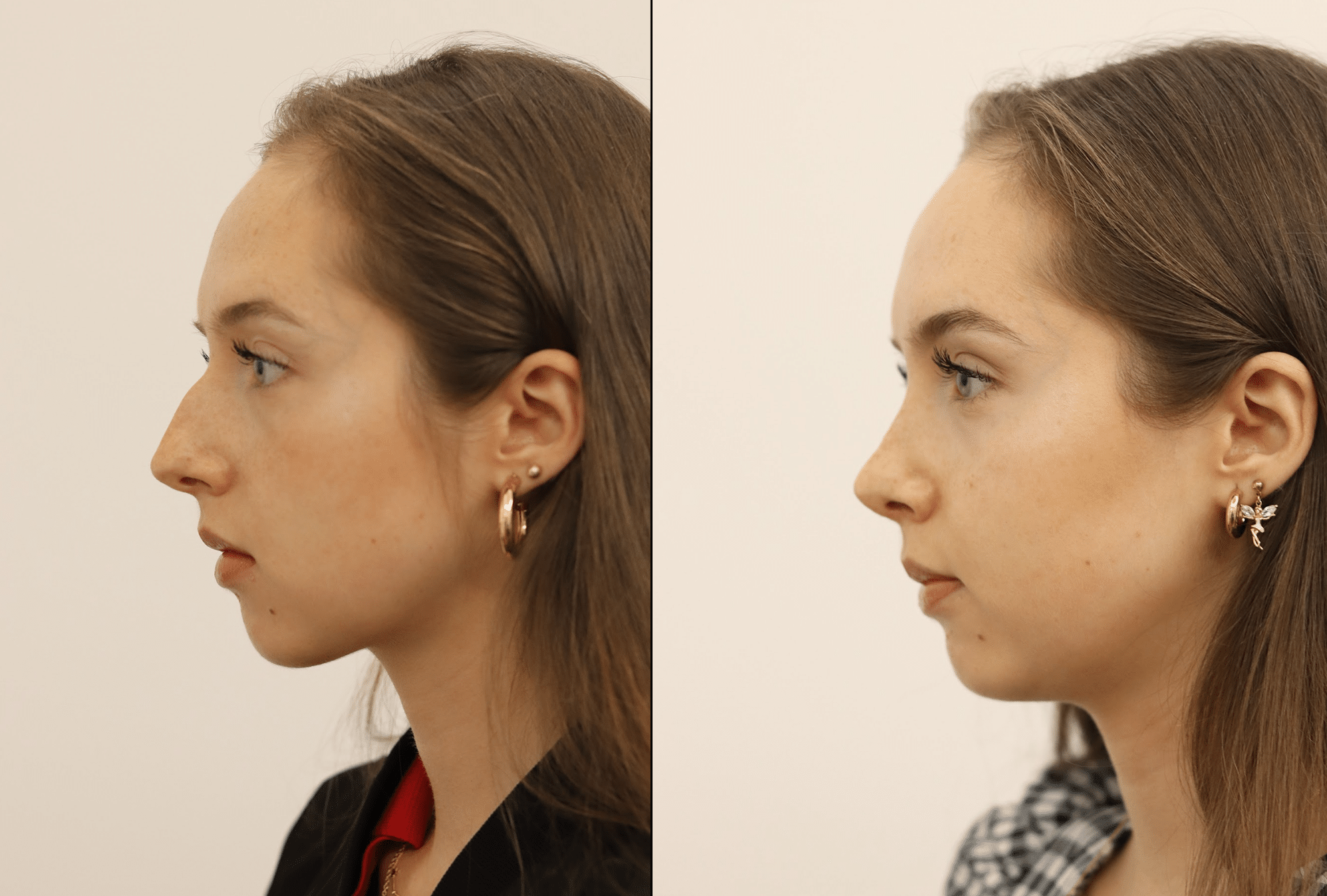 Facelift Before & After Photos - Facelift Surgery London