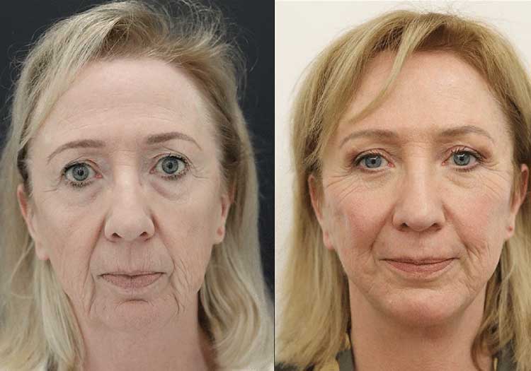 Facelift & Neck Lift Before & After Surgery in London