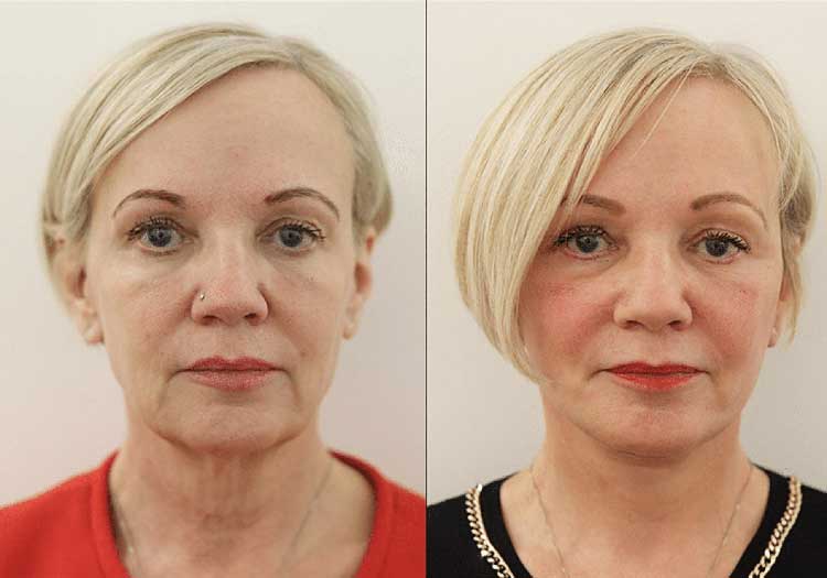 Facelift & Neck Lift Before & After Surgery in London