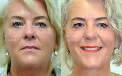 Unlocking Beauty: The Evolution of Facelift Techniques