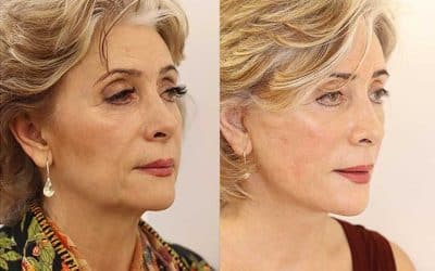 Facelift & Neck Lift: Restoring Harmony to Your Features