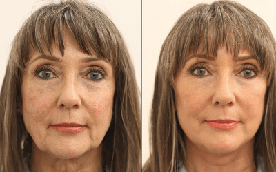 Maximising Results: Combining Facelift with Other Cosmetic Procedures and Specialist Recovery Techniques